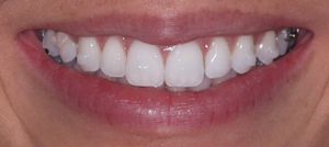 Final nine month smile close-up