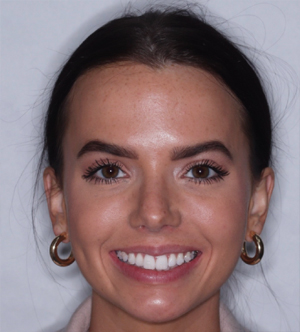 Final nine month full-face case photo