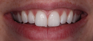 Initial smile close-up