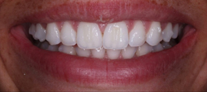 Three month progress smile close-up