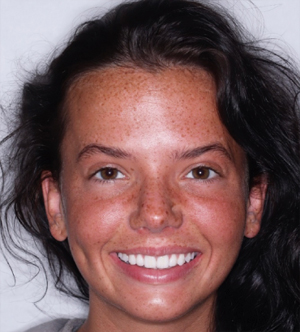 Three month progress full-face case photo